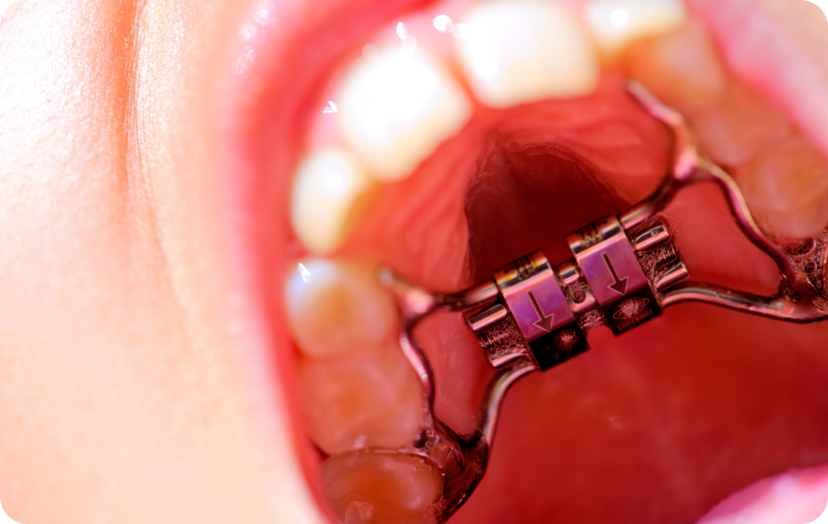 activation disjoncteur charenton le pont Nos conseils Dr Déborah Fellous, Orthodontiste à Charenton-le-Pont