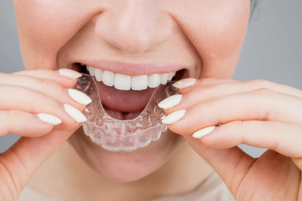Orthodontie de l'adulte Dr Déborah Fellous | Orthodontiste à Charenton-le-Pont