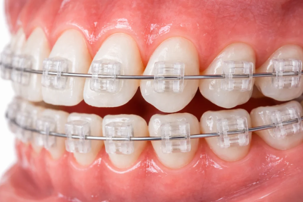 Orthodontie de l'adulte Dr Déborah Fellous | Orthodontiste à Charenton-le-Pont