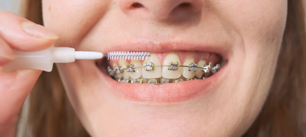 brossage bagues charenton le pont ceramiques Orthodontie de l’adolescent Dr Déborah Fellous | Orthodontiste à Charenton-le-Pont