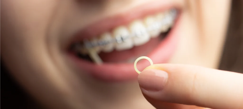 consultation orthodontiste fellous appareils dentaires elastiques Port d'élastiques inter-arcades Dr Déborah Fellous, Orthodontiste à Charenton-le-Pont
