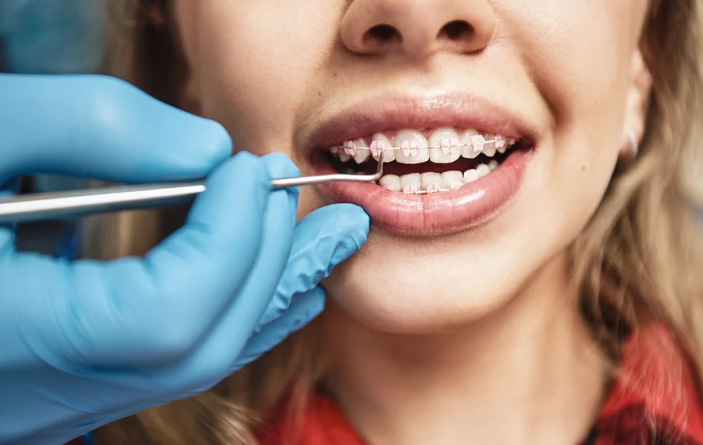 Incidents en orthodontie