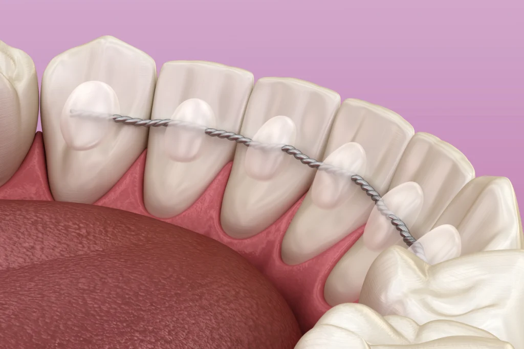 consultation adulte orthodontiste saint mande contention Orthodontiste à Saint-Mandé Dr Déborah Fellous, Orthodontiste à Charenton-le-Pont